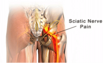Sciatica…a pain in the butt!