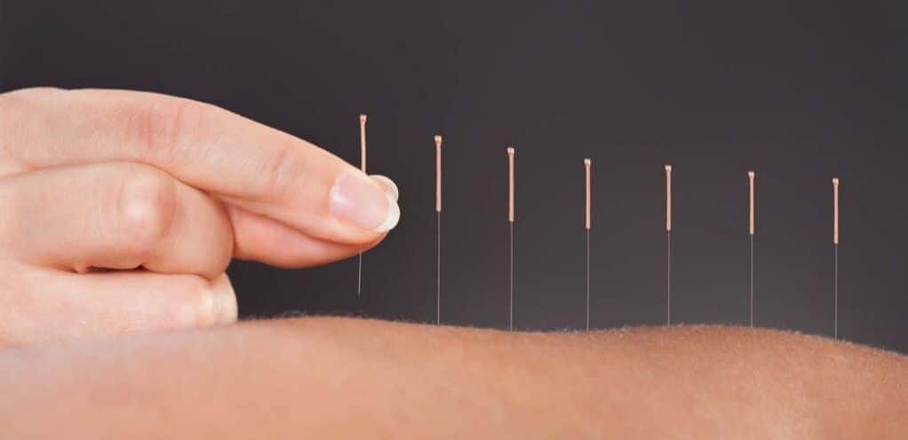 What is Medical Acupuncture, and How can it help?